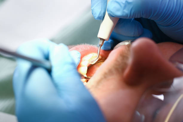 Best Knocked-Out Tooth (Avulsed Tooth) Treatment in Patterson, LA