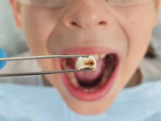 Best Emergency Dental Care for Sports Injuries in Patterson, LA